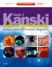 Signs in Ophthalmology: Causes and Differential Diagnosis Expert Consult - Online and Print
